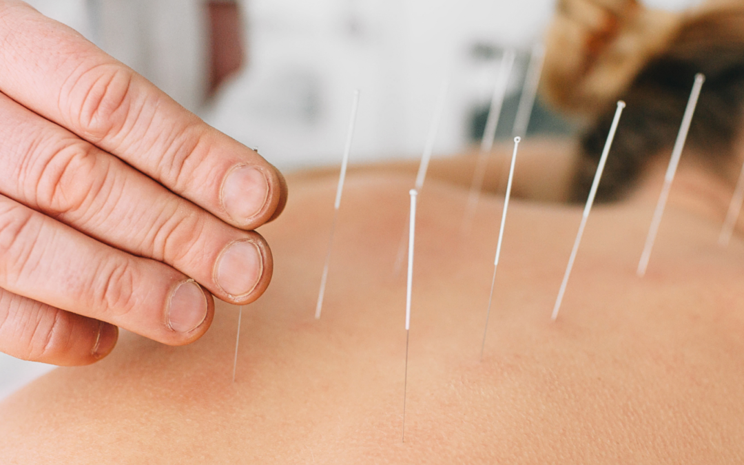 Acupuncture
