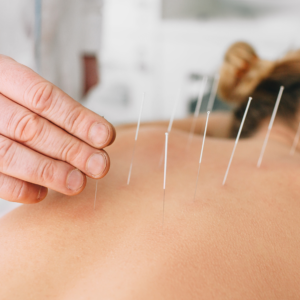Acupuncture