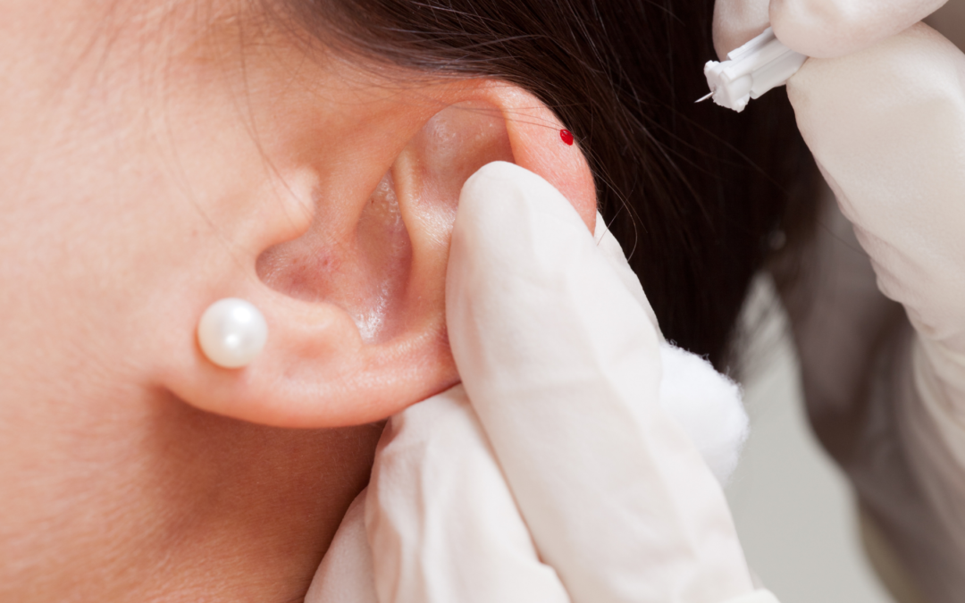Auricular Therapy