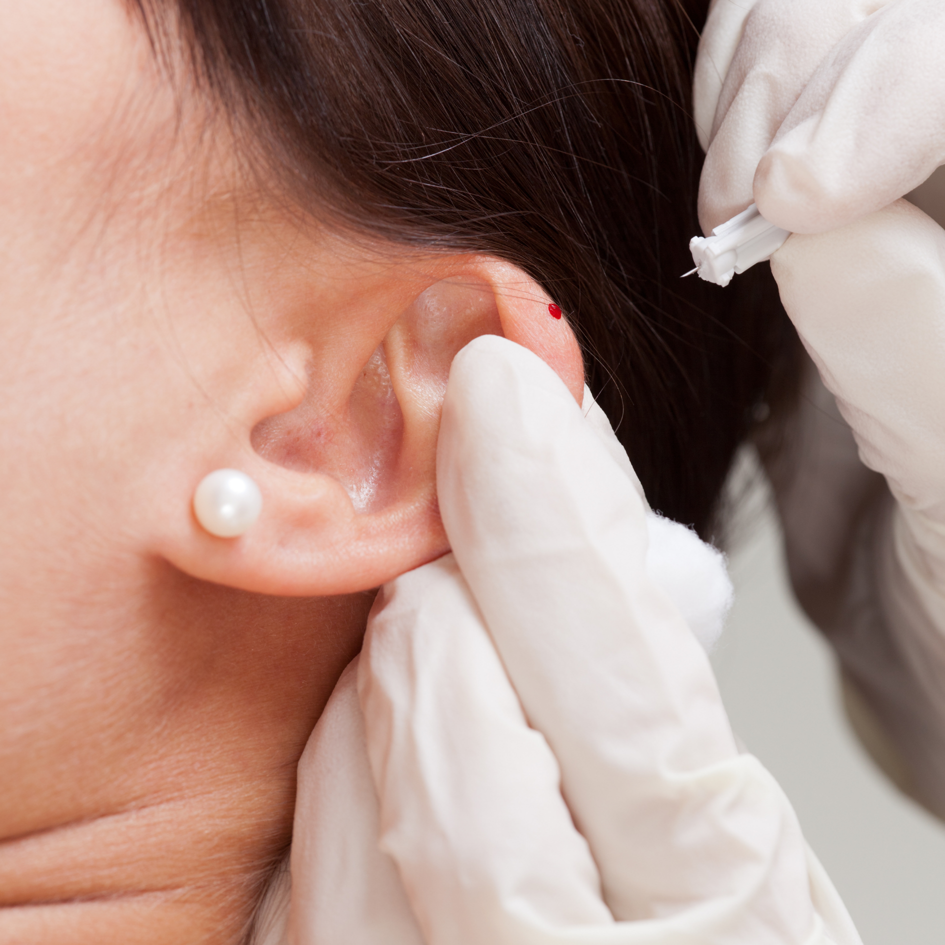 Auricular Therapy