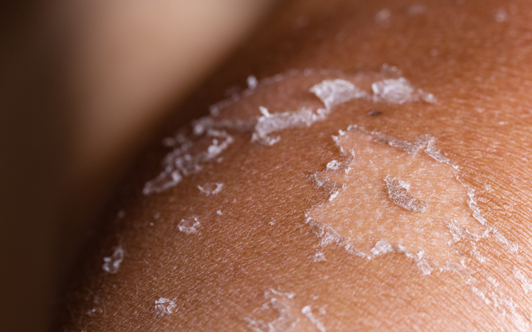Body Peel