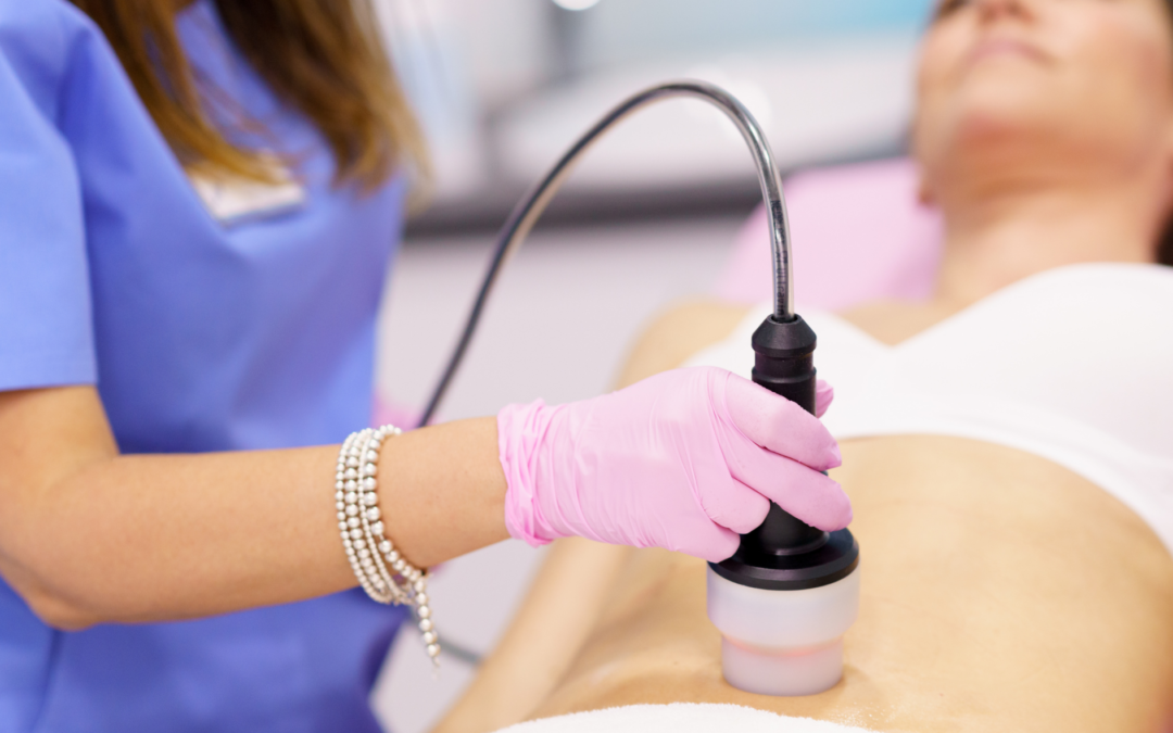 Bodytite (radiofrequency)