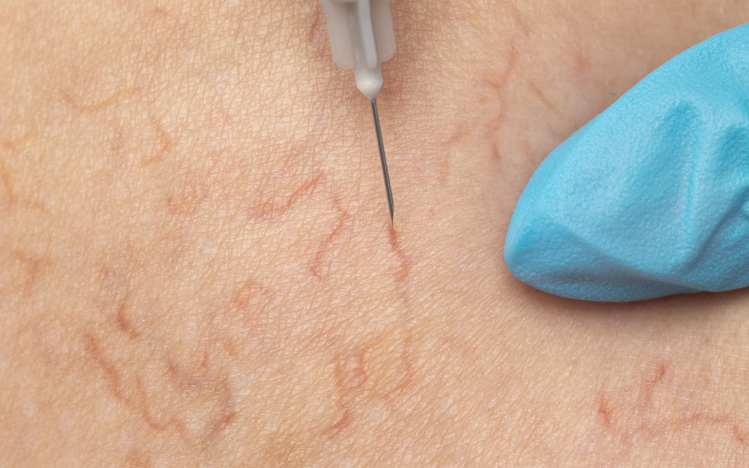 Capillary Removal