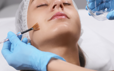 Chemical Peels