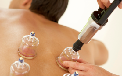 Cupping