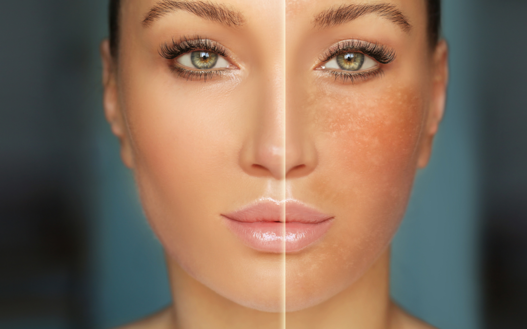 Hyperpigmentation