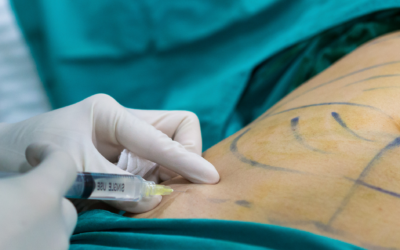 Liposculpture