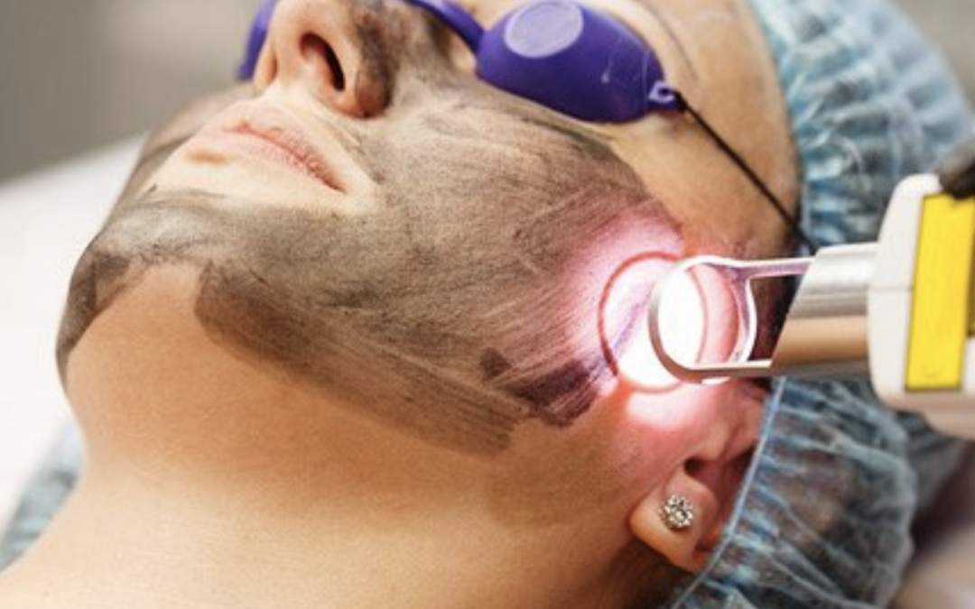 Melasma Removal