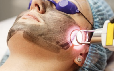 Melasma Removal