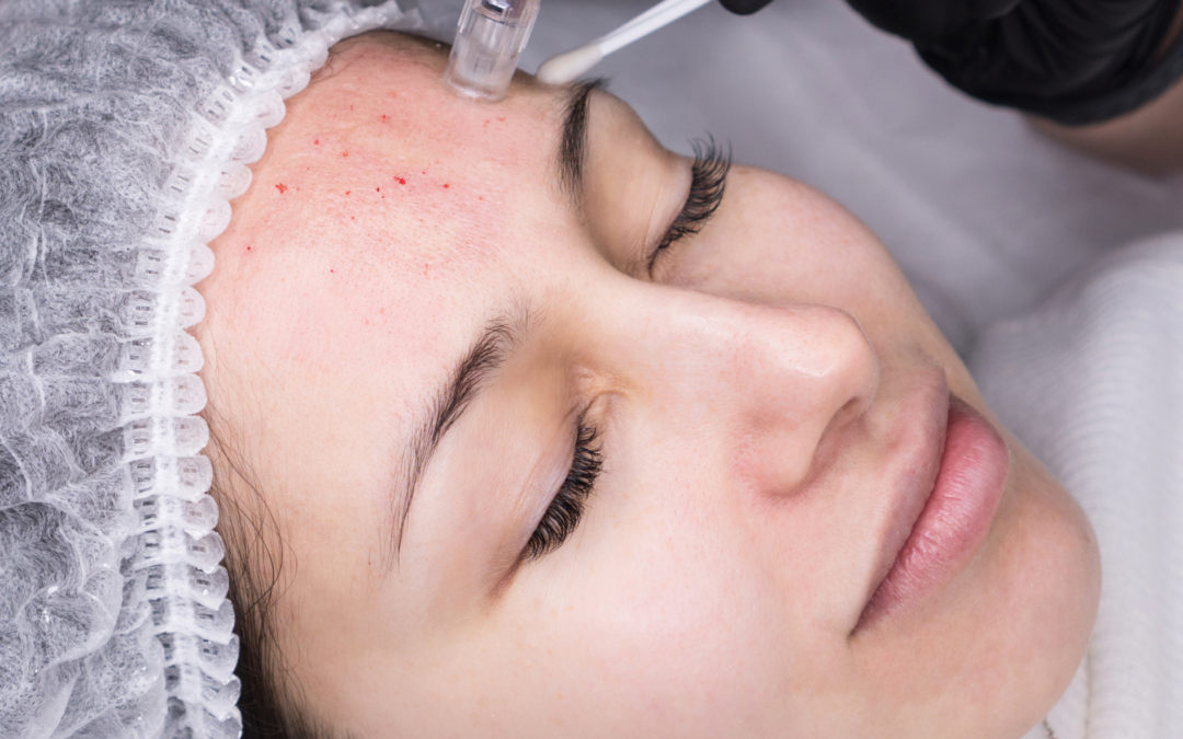 Micro-Needling