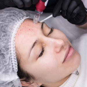 Micro-Needling
