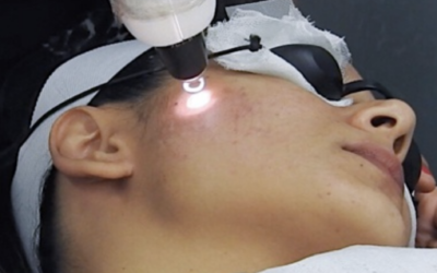 PIGMENTATION REMOVAL